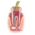 Illustration of an infected tooth receiving root canal therapy to save it from extraction