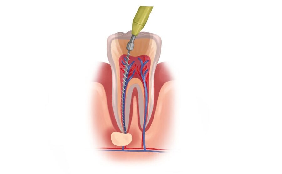 Illustration of an infected tooth receiving root canal therapy to save it from extraction