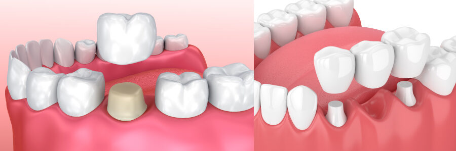 Illustrations of a dental crown next to a dental bridge, dentist in wynne