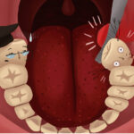 Illustration of wisdom teeth being extracted from a lower jaw