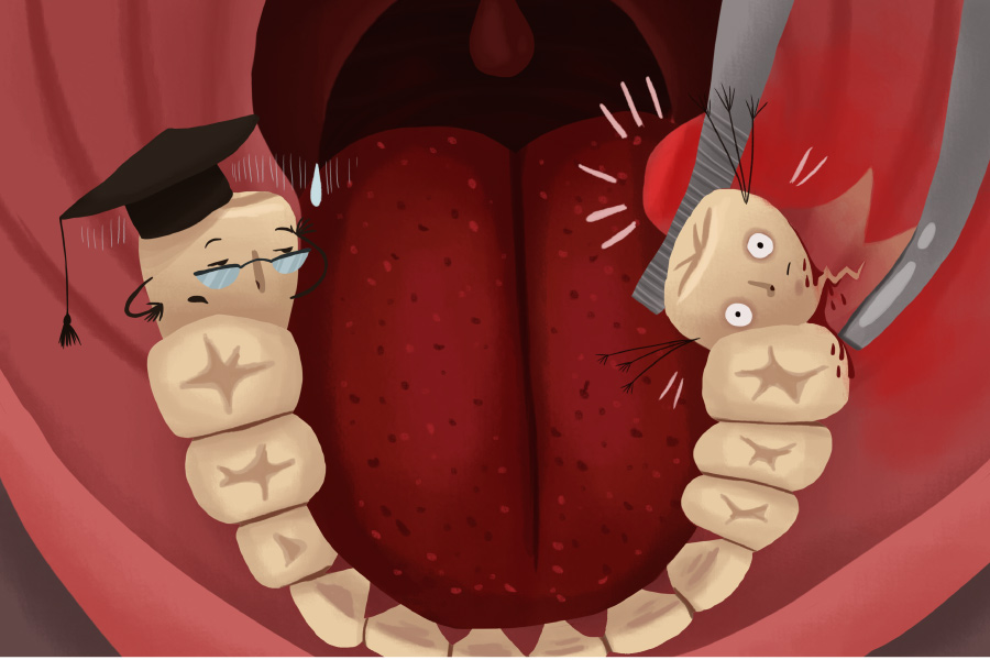 Illustration of wisdom teeth being extracted from a lower jaw, dentist in wynne