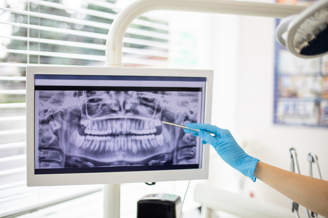 digital x-rays, digital xrays, digital radiographs, dentist in Wynne