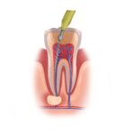 root canal therapy, dentist in Wynne