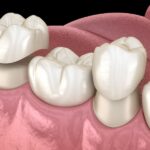 dental crown care, crown maintenance, dental crown tips, oral hygiene, Wynne AR dentist, Toland Dental, crown longevity, dental health