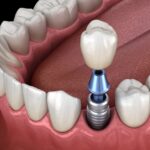 ental implants, dentist in Wynne, AR, dental implant care, dental implants lifespan, dental implant tips