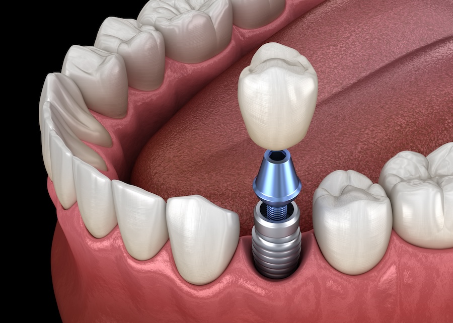 ental implants, dentist in Wynne, AR, dental implant care, dental implants lifespan, dental implant tips