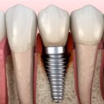 image of peri implantitis, gum disease, dental implants, peri-implantitis, oral hygiene, implant care, Toland Dental, Wynne, AR