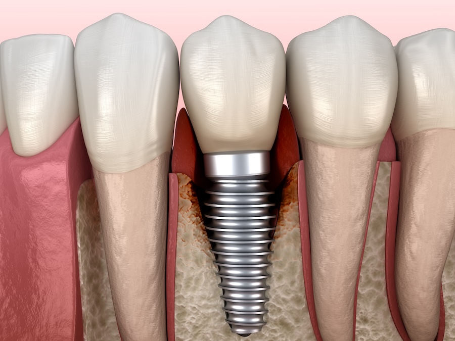 image of peri implantitis, gum disease, dental implants, peri-implantitis, oral hygiene, implant care, Toland Dental, Wynne, AR