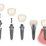 dental implant parts