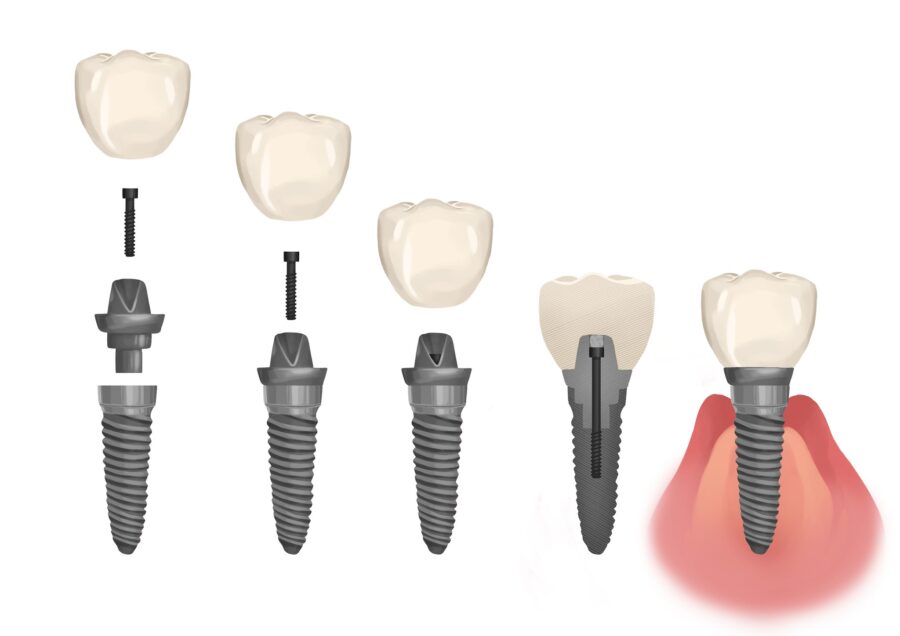 dental implant parts