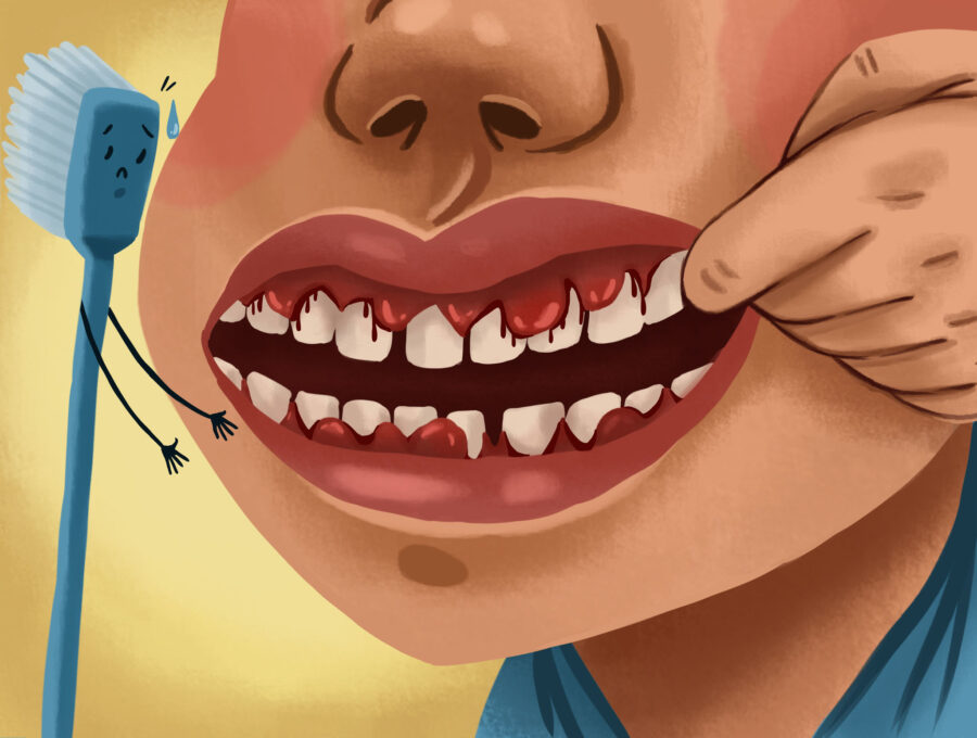 person with bleeding gums, a sign of gingivitis and early gum disease