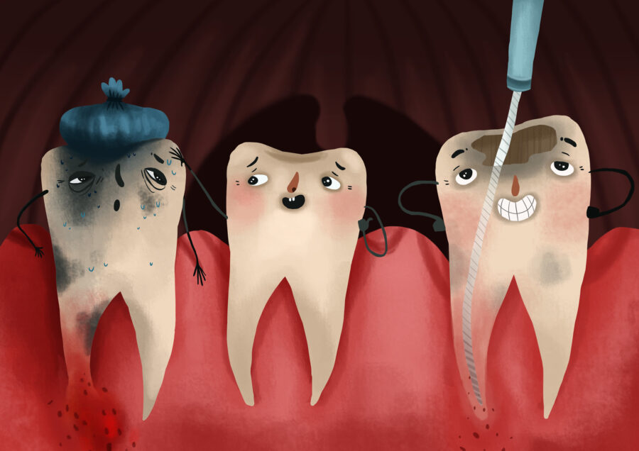 graphic art of root canal therapy on a molar tooth