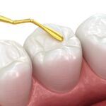 replacing dental filling, old fillings, old dental fillings