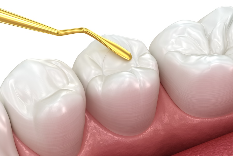 replacing dental filling, old fillings, old dental fillings